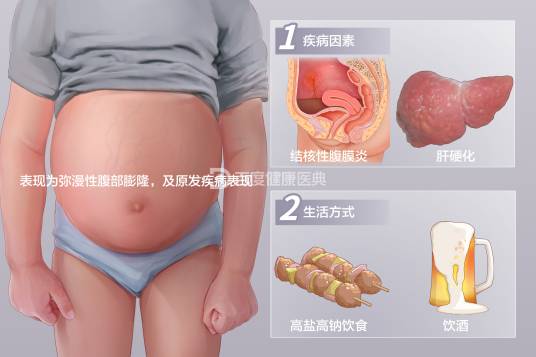 腹腔积液（病症）