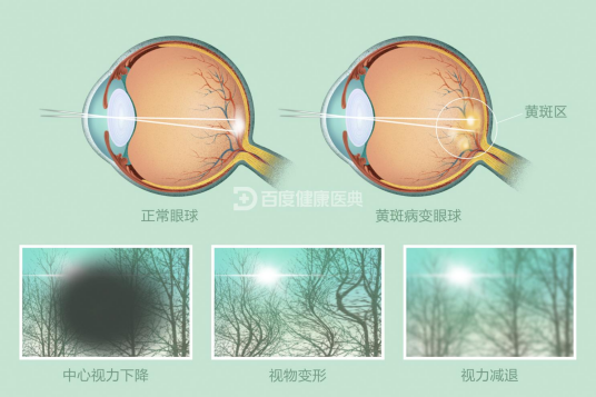 黄斑病变