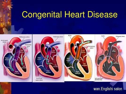 先天性心脏病（先天性心脏病先心病）