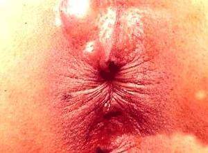 直肠肛门内胀痛不适