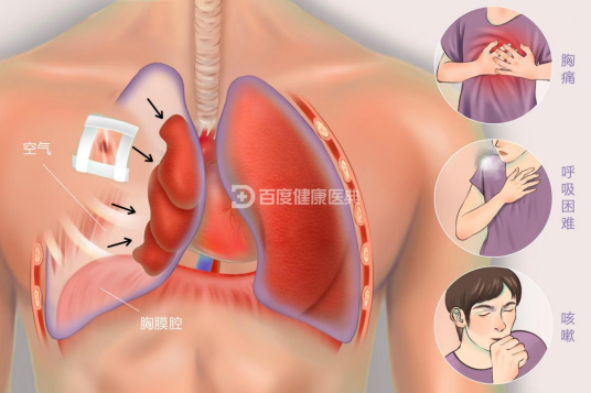 气胸