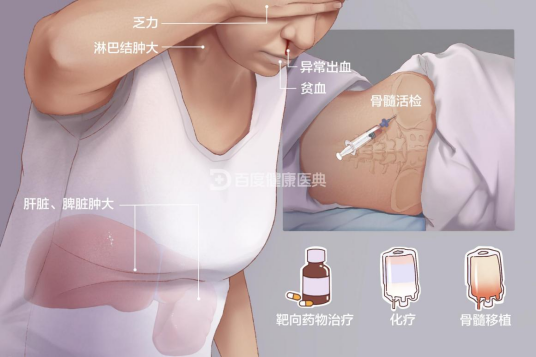 白血病（造血干细胞恶性克隆性疾病）