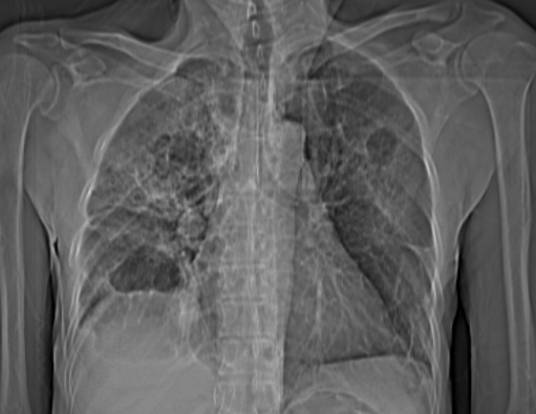 中性粒细胞百分比