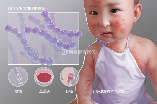 猩红热（疾病名）