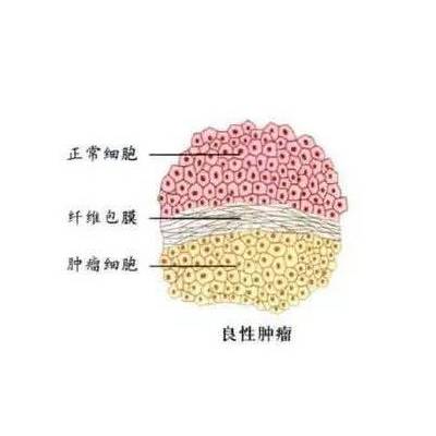 良性肿瘤
