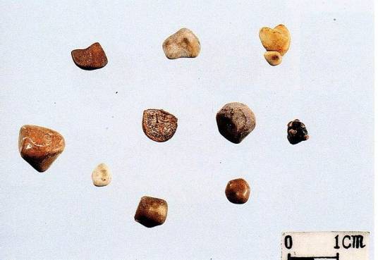 泌尿系结石（泌尿系的常见病）