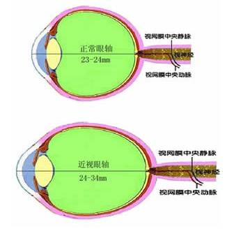近视眼手术后遗症
