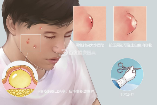 皮脂腺囊肿