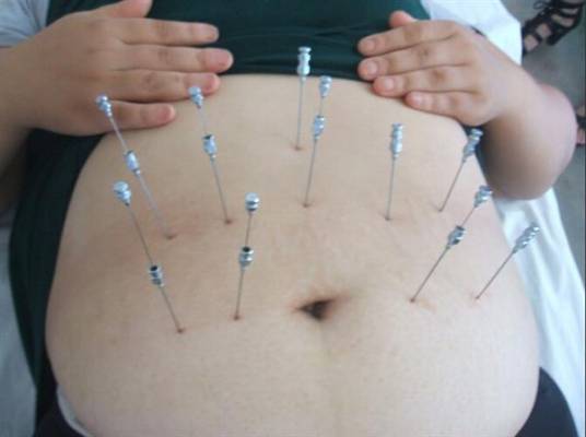 经络埋线减肥