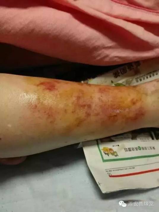 皮肤及软组织感染