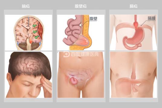 疝（病症名）
