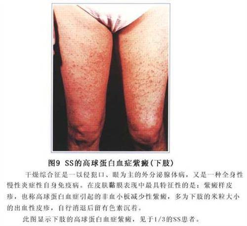 原发性干燥综合症