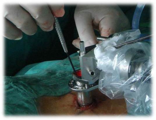 椎间盘微创手术