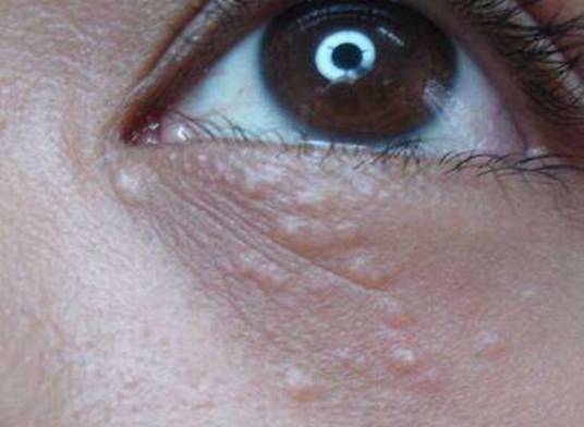 眼部扁平疣