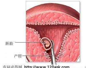 可视人工流产
