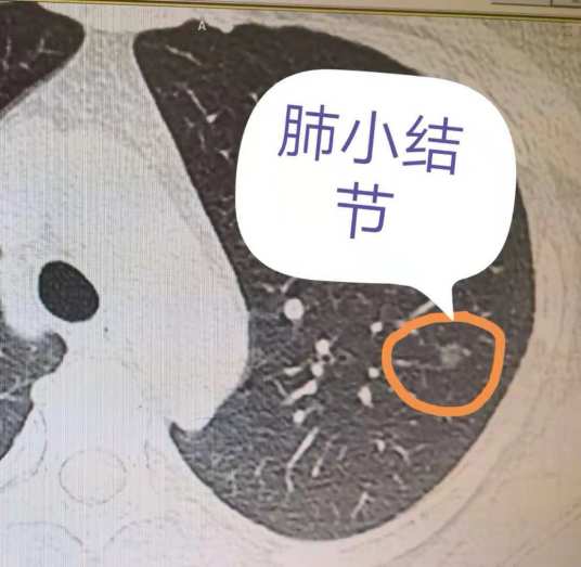 肺部小结节