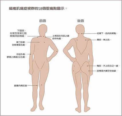 纤维性肌痛综合症