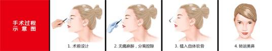 自体软骨隆鼻手术