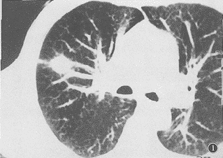 肺癌血管集束征