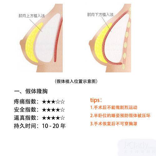 自体脂肪隆胸术