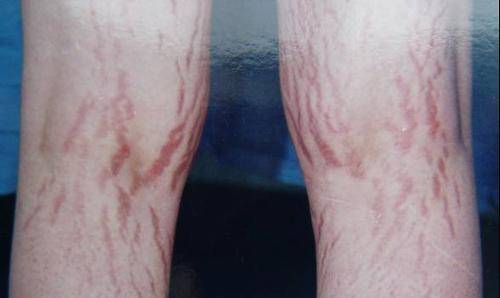 紫纹（医学用语）