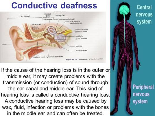 传导性耳聋