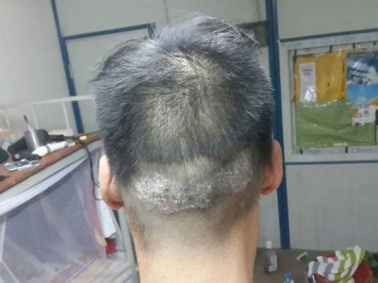 头皮型银屑病