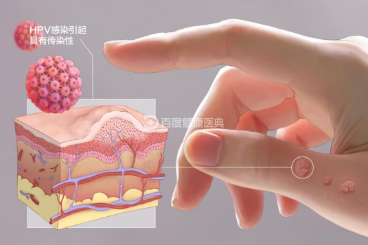 疣（人类乳头瘤病毒引起的皮肤表面赘生物）