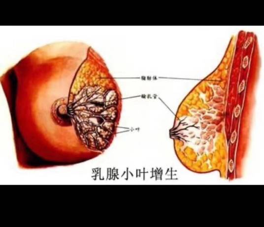 双乳腺小叶增生
