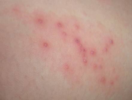 药物过敏荨麻疹