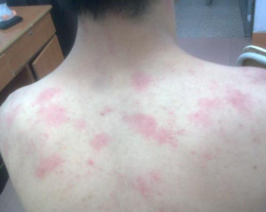 胆碱荨麻疹