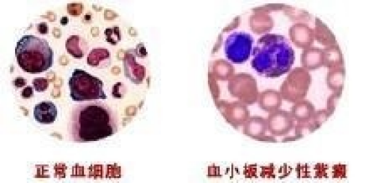 血小板减少性紫癜症