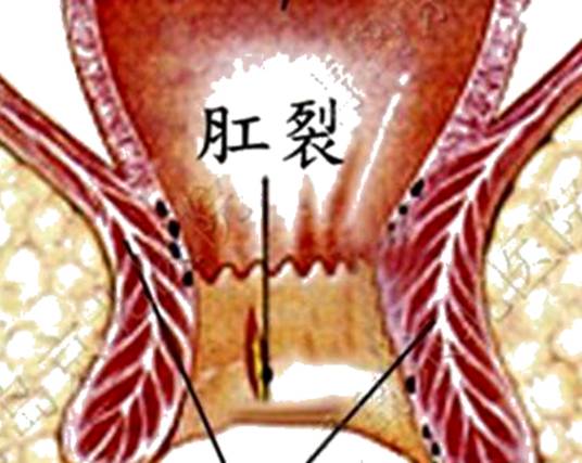 肛裂出血
