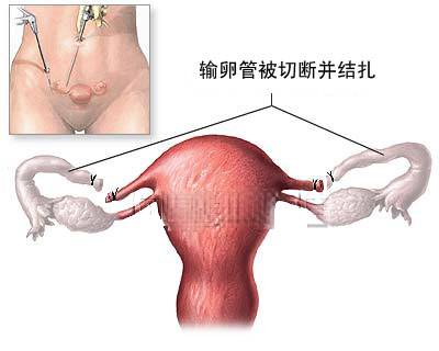 绝育术