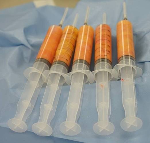 自体脂肪移植术