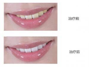 牙齿漂白