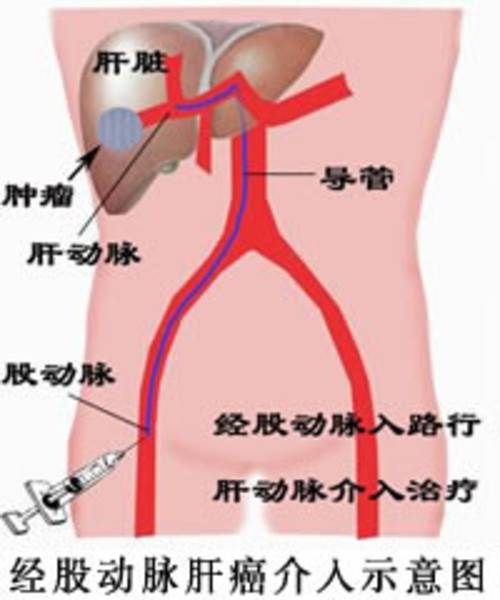 肝癌介入治疗