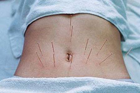 腹针疗法（针刺方法）