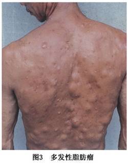多发性脂肪瘤