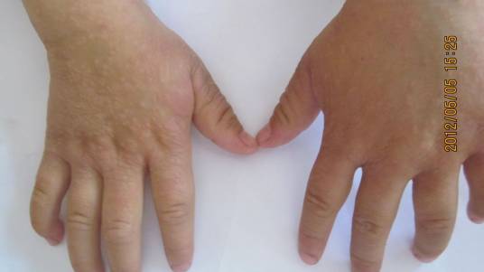 摩擦性苔癣样疹