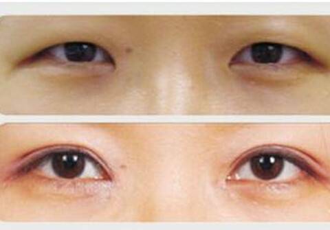 上睑下垂矫正技术