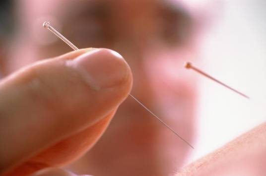 针灸疗法（中国医学治疗方法）