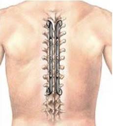 强直性脊柱炎早期