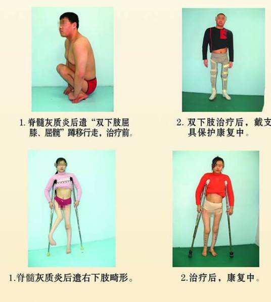 小儿麻痹后遗症