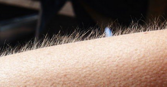 鸡皮疙瘩（生理学名词）