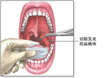 扁桃体摘除术