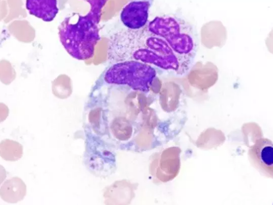 嗜血细胞综合症