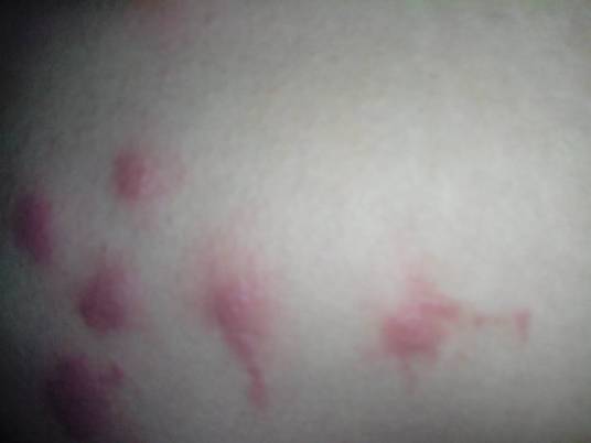 过敏性皮炎症状