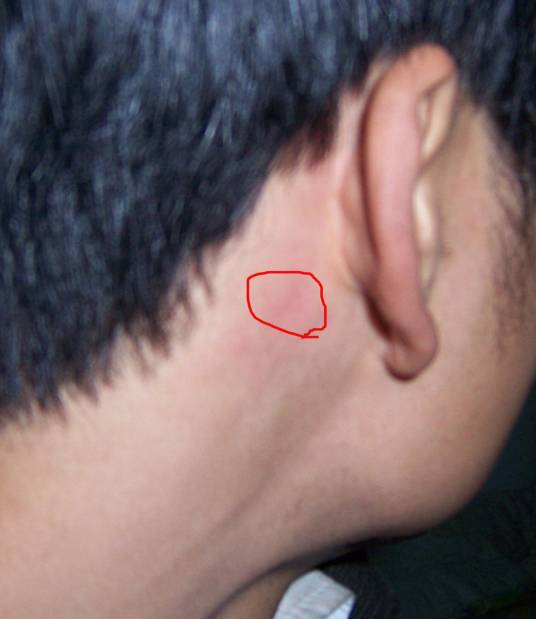 耳后疼痛