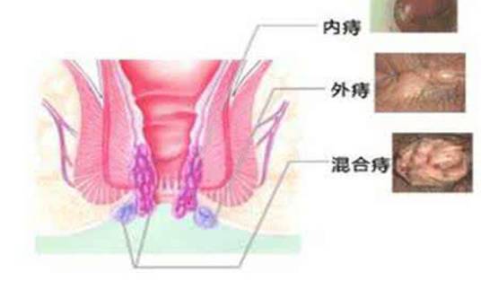 混合痔疮